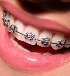 braces-aligner-2